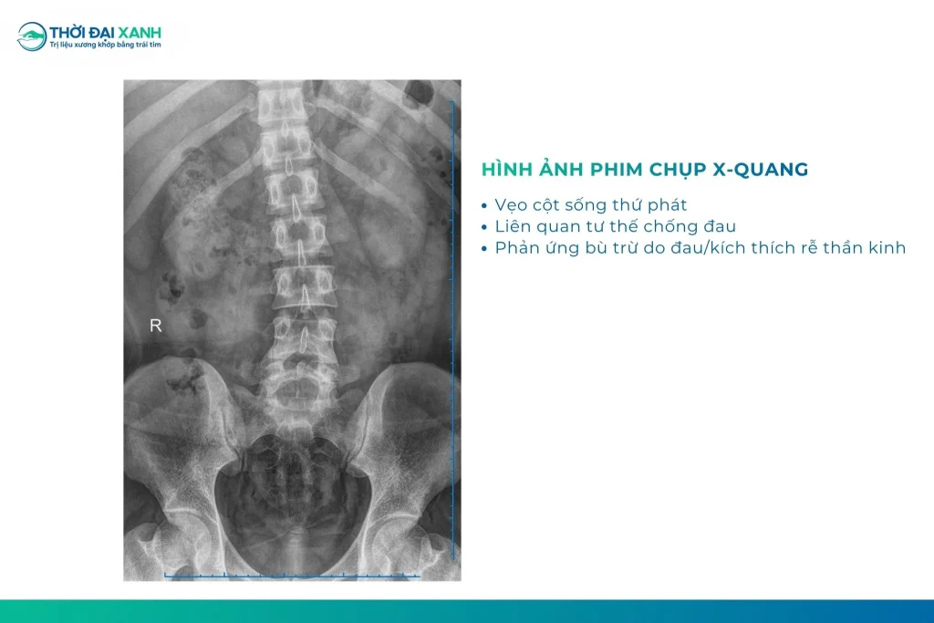 Thoát vị đĩa đệm gây kích thích, chèn ép rễ thần kinh có thể hình thành tư thế chống đau, dẫn đến vẹo cột sống thứ phát và thay đổi dáng đi.