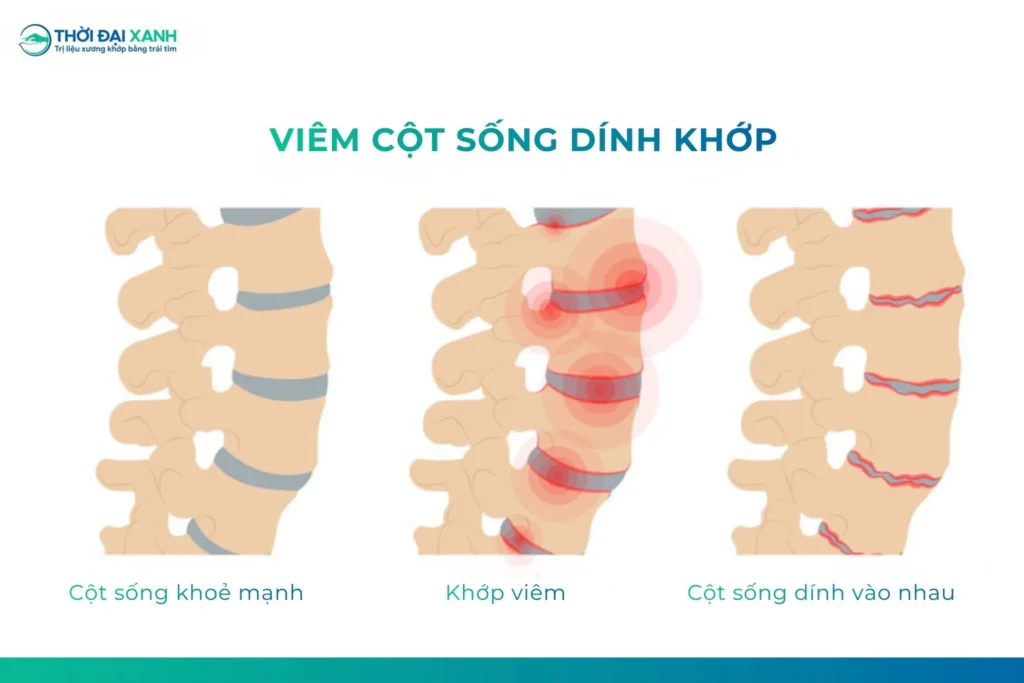 Viêm cột sống dính khớp là bệnh viêm mạn tính, chủ yếu ảnh hưởng đến khớp cùng chậu, cột sống và có thể gây dính khớp khi bệnh tiến triển.