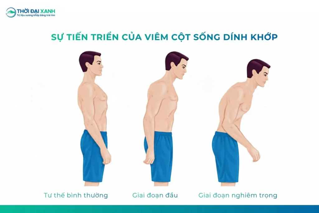 Nguyên nhân viêm cột sống dính khớp chưa được xác định rõ, nhưng bệnh có liên quan đáng kể đến yếu tố di truyền, đặc biệt là HLA-B27.