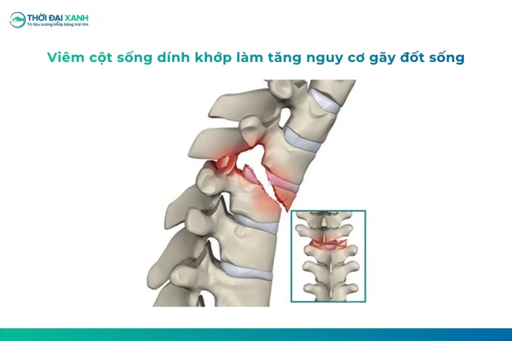 Viêm cột sống dính khớp tiến triển có thể làm hạn chế vận động, ảnh hưởng khớp háng và tăng nguy cơ gãy cột sống khi cột sống trở nên cứng, kém linh hoạt.