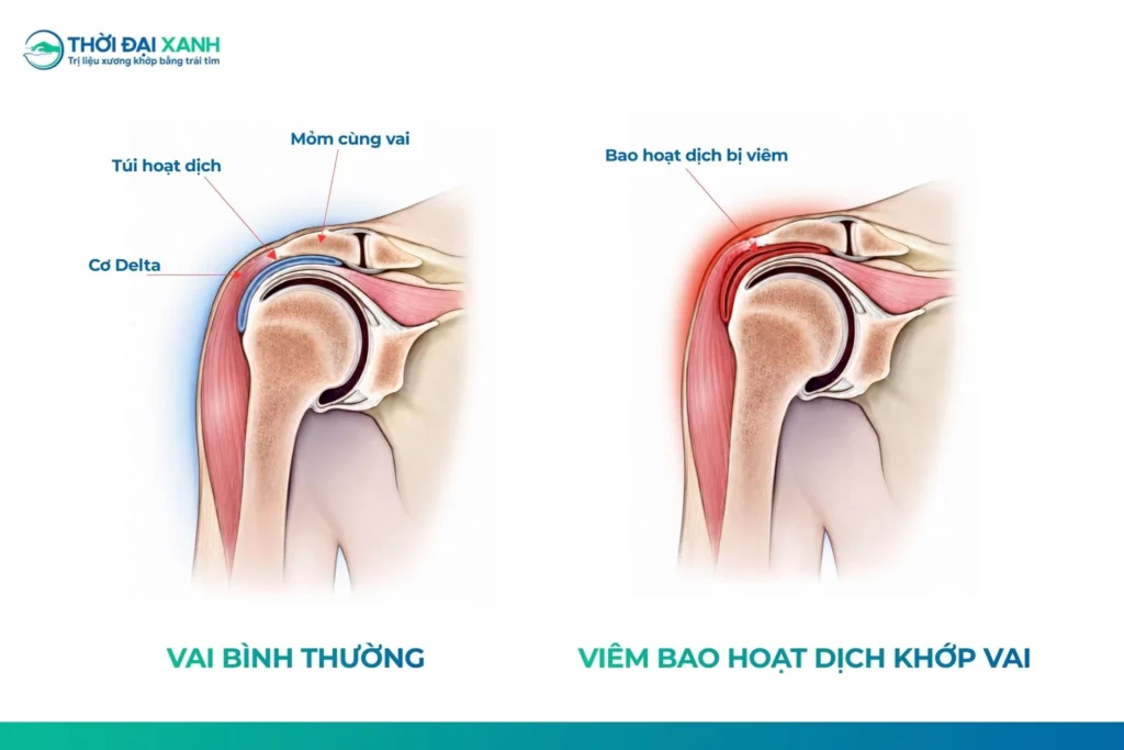 Tổn thương gân cơ chóp xoay khớp vai thường gây đau, yếu cánh tay và hạn chế các động tác giơ cao, xoay hoặc đưa tay ra sau lưng.