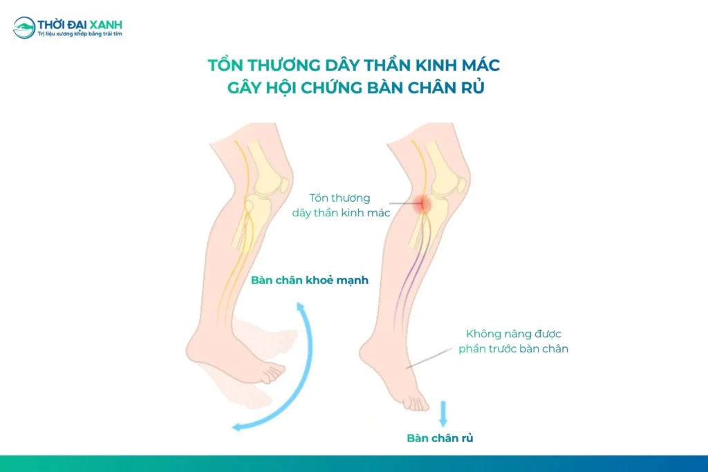Thoát vị đĩa đệm gây yếu chân và hội chứng bàn chân rủ do chèn ép rễ thần kinh.
